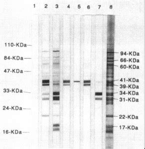 elisa test lyme|positive western blot test lyme.